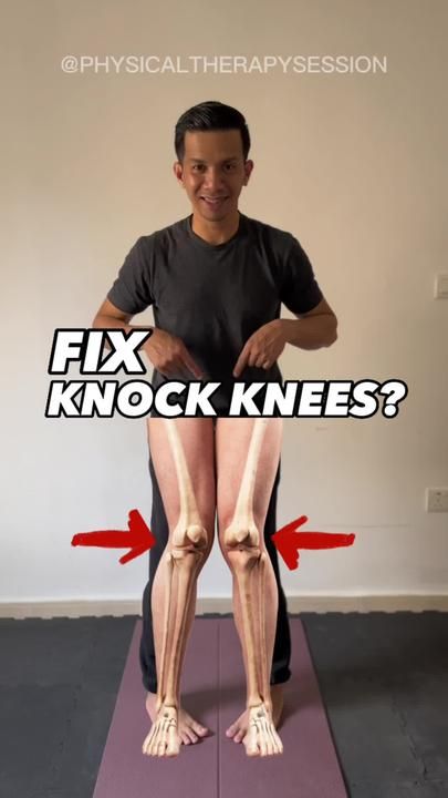 Fix Knock Knees, Knock Knees Exercises, Knee Pain Relief Exercises, Hyperbolic Stretching, Stretching Program, Knock Knees, Gymnastics Stretches, Thighs Exercises, Quad Exercises