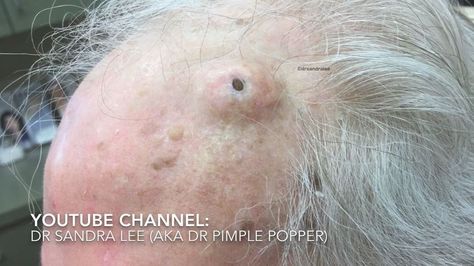 Watch Dr. Pimple Popper Extract This Massive Blackhead From a Man’s Scalp | Allure Huge Blackheads, Pimples Around Mouth, Pimples On Scalp, Head Pimples, Pimple Popper Videos, Pimples On Buttocks, Pore Extraction, Pimple Popper Videos Black Heads, Pimple Extraction