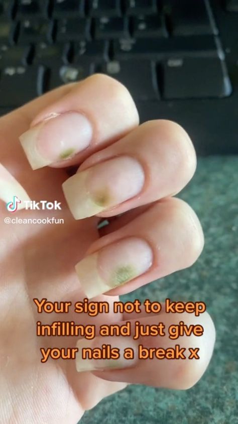 Green Nail Syndrome, Nail Growth Faster, Toe Nail Fungal Infection, Lemon Health, Fingernail Fungus, Nail Remedies, Nail Fungus Remedy, So Disappointed, Nail Infection