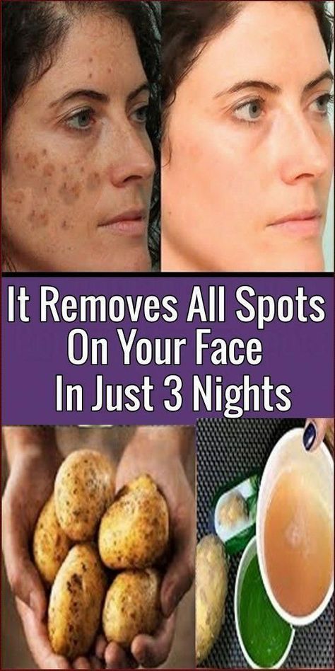 How To Get Rid Of Wrinkles Using Coconut Oil Bleaching Your Skin, Brown Spots On Skin, Dark Spots On Face, Brown Spots Removal, Brown Spots On Face, Dark Spots On Skin, Skin Spots, Spots On Face, Remove Dark Spots