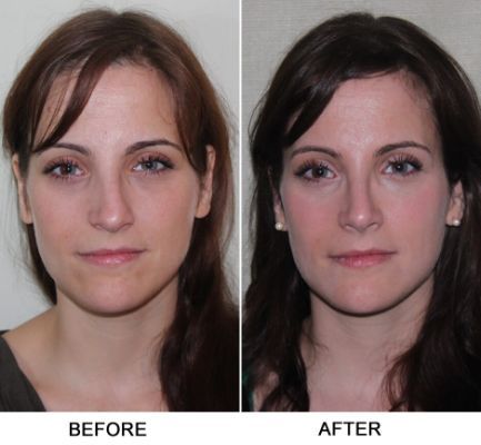 septoplasty turbinate reduction - Yahoo Search Results Broken Nose Surgery, Kpop Plastic Surgery, Jaw Reduction Surgery, Ethnic Rhinoplasty, V Line Surgery, Lipo Before And After, Plastic Surgery Fail, Rhinoplasty Nose Jobs, Plastic Surgery Gone Wrong