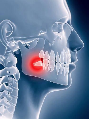 Wisdom Teeth Swelling, Impacted Wisdom Teeth, Surgeon Office, Surgeon Quotes, Tooth Extraction Aftercare, Bone Infection, Wisdom Teeth Pain, Tooth Extraction Healing, Impacted Tooth