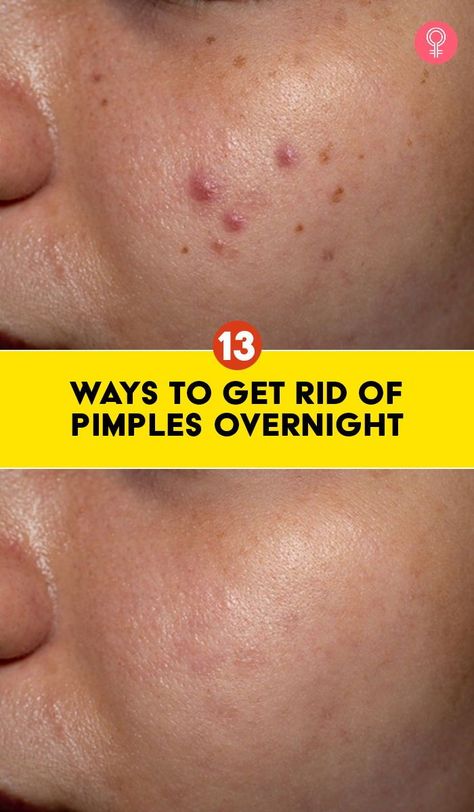 Hide Pimples With Makeup, White Bumps On Face, Tips For Pimples, Pimples Skin Care, How To Hide Pimples, Mask For Pimples, Bumps On Face, Nits Removal, Diy Face Mask For Acne