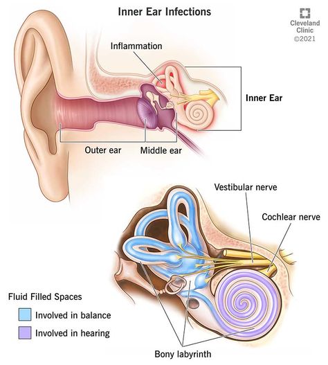 Inner Ear Infection: Symptoms, Signs & Causes Inner Ear Anatomy, Ear Drainage, Eustachian Tube Dysfunction, Neurological Assessment, Ear Anatomy, Vestibular System, Outer Ear, Basic Anatomy And Physiology, Middle Ear