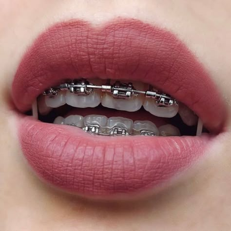 Perfect Teeth Braces, Teeth Aesthetic, Cute Braces Colors, Pretty Teeth, Braces Tips, Getting Braces, Braces Girls, Cute Braces, Brace Face