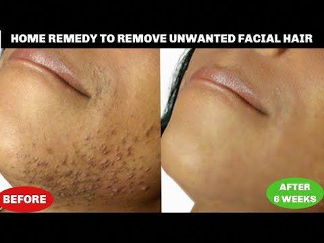 #Khichibeauty #khichibeautytipsGET RID OF UNWANTED FACIAL HAIR AT HOME, REMOVE CHIN HAIR + UPPER LIPS, NO SHAVE NO WAX25 DAYS SKINCARE CHALLENGE PLAYLISTht... Skincare Challenge, Waxing Vs Shaving, Natural Hair Removal Remedies, Chin Hair Removal, Upper Lips, Female Facial Hair, Bump Hairstyles, Upper Lip Hair, Face Hair Removal