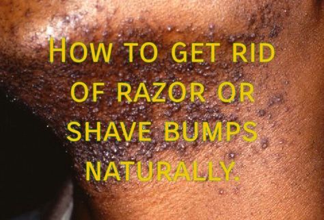 Remove Razor Bumps, Hair Lossing Tips, Razor Burn Remedies, Burn Remedies, Hair Lossing, Razor Bumps Remedy, Waxing Vs Shaving, Diy Tanning, Facial Remedies