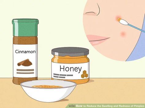 Swelling Remedies, Reduce Pimple Redness, Painful Pimple, Redness Pimple, Blind Pimple, Pimples Under The Skin, How To Reduce Pimples, Pimples Remedies, Acne Mask