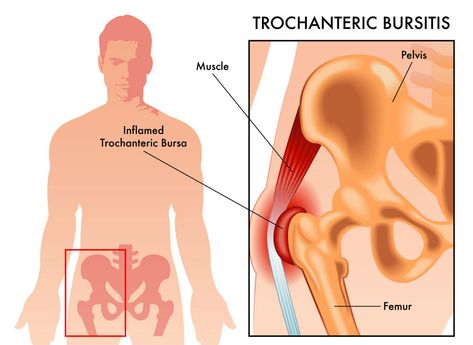 Bursitis Hip Relief, Greater Trochanteric Pain Syndrome, Hip Implants, Best Exercise For Hips, Bursitis Hip, Hip Injuries, Hip Pain Relief, Lower Back Pain Relief, Hip Pain