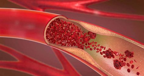 What Does a Blood Clot Feel Like? Experts Share Common Signs and Symptoms High Triglycerides, Coronary Arteries, Shortness Of Breath, Circulatory System, Chest Pain, Diet Supplements, Cardiovascular Health, Cardiovascular Disease, Lower Blood Pressure