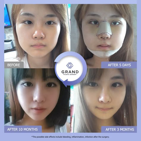 Korean Plastic Surgery Before And After, South Korean Plastic Surgery, V Line Surgery, Plastic Surgery Fail, V Line Face, Korean Plastic Surgery, Horrible Tattoos, V Shape Face, Master Tattoo