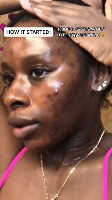 How to clear Acne Hyperpigmentation Completely Hyperpigmentation Black Skin, Face Map, Back Acne Remedies, Oily Acne Prone Skin, Acne Hyperpigmentation, Facial Scars, Forehead Acne, Allies Of Skin, Acne Face