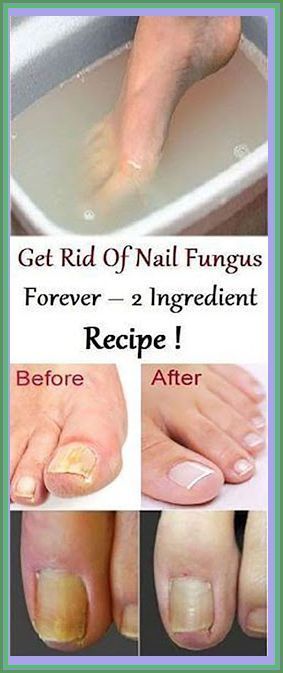 Natural Pedicure Ideas, Natural Pedicure, Toenail Health, 2 Ingredient Recipes, Baking Soda Vinegar, Pedicure Ideas, Fungal Nail, Baking Soda Uses, Baking Soda Shampoo