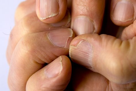 Split Nails, Cracked Nails, With Nails, Brittle Nails, Nail Fungus, Dry Nails, Nailed It, Healthy Nails, Health And Beauty Tips