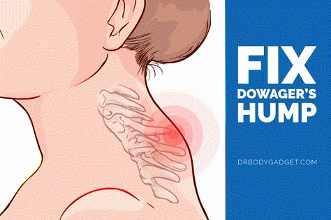 Learn what causes some people to develop a hump on their neck and how to fix it using the best dowager's hump exercises. READ MORE. Neck Hump Exercises For Women, Dowagers Neck Exercises, Hump On Back Of Neck, Fix Neck Hump, Dowager Hump, Dowagers Hump, Dowager's Hump, Neck Exercise, Better Posture Exercises