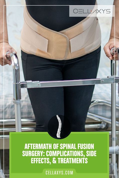 Aftermath of Spinal Fusion Surgery Complications, Potential Side Effects, Treatments Sciatic Nerve Relief, Spinal Fusion Surgery, Sciatic Nerve Pain Relief, Spinal Fusion, Spinal Surgery, Spinal Injury, Spine Health, Spine Surgery, Nerve Pain Relief