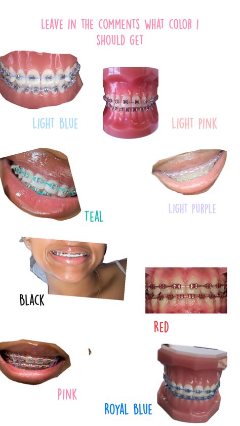 Power Chain Braces, Dental Braces Colors, Braces Colors Combinations, Pink Braces, Braces Bands, Cute Braces Colors, Pretty Teeth, Braces Tips, Getting Braces