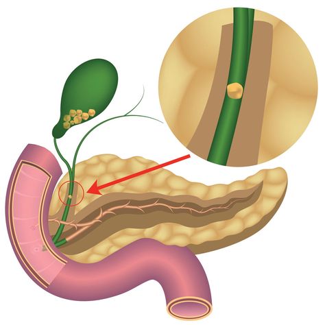 𝗚𝗮𝗹𝗹𝗯𝗹𝗮𝗱𝗱𝗲𝗿 𝘀𝘁𝗼𝗻𝗲𝘀 𝘀𝘆𝗺𝗽𝘁𝗼𝗺𝘀 Discomfort or pain in the right upper abdomen Pain radiating to the right shoulder or the back Nausea or vomiting Heartburn, gas, indigestion Frequent digestion issues Yellow skin or eyes Dark urine Fevers and chills For More Information 098930 74467 https://www.shantirajhospital.com/about-gallbladder-stones/#Gallbladder_stones_symptoms Gallbladder Stones, Gall Bladder, Yellow Skin, Eyes Dark, Skin, Health, Stone, Yellow, Quick Saves