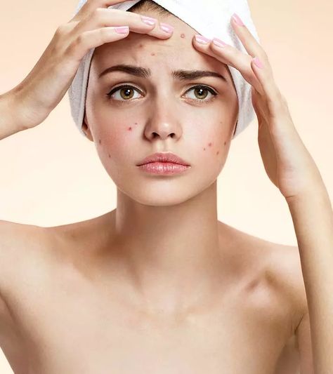 19 Best Home Remedies To Get Rid Of Blemishes On Face Forehead Acne, Remedies For Acne, Dark Spots On Face, Natural Acne Remedies, Diy Kosmetik, Natural Acne, How To Get Rid Of Pimples, Best Skin Care Routine, Acne Remedies