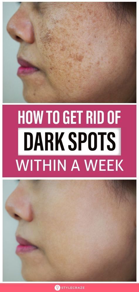 Here’s how to get rid of dark spots. Wrinkle Remedies, Wrinkle Free Skin, Dark Spots On Face, Brown Spots Removal, Brown Spots On Face, Skin Spots, Spots On Face, Cosmetic Treatments, Remove Dark Spots