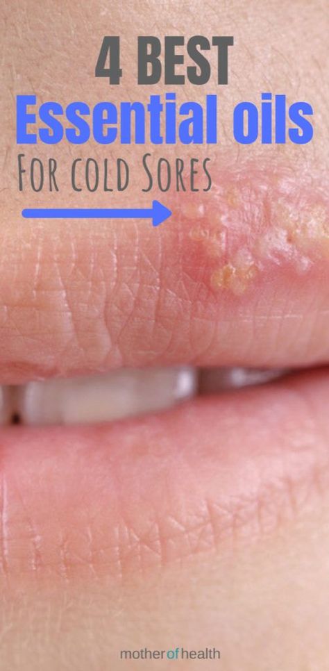 The 4 Best Essential Oils for Cold Sores Essential Oils For Cold Sores On Lip, Essential Oils For Fever Blister, Fever Blister Remedy Fast How To Get Rid, Essential Oil For Cold Sore On Lip, Fever Blister Essential Oils, Fever Blister Remedy Fast, Essential Oils For Fever, Cold Sore Essential Oil, Antiviral Essential Oils