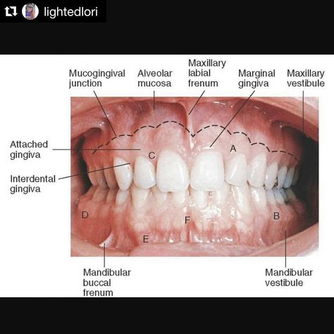 Periodontology on Instagram: “#Repost @lightedlori with @repostapp #gingiva #mucosa #periobasics #periodontology” Dental Assistant Study Guide, Dental Notes, Dental Assistant School, Dental Hygienist School, Dental Assistant Study, Dental Hygiene Student, Dental World, Dental Education, Dental Assisting