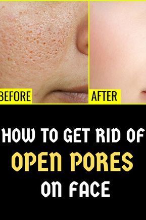 Want to know about HOW TO GET RID OF OPEN PORES ON FACE? We have listed natural home remedies for close open pores. #openpores #skincare #homeremedies How To Close Pores, Nails Remedies, Open Pores On Face, Skin Care Procedures, Pores On Face, Lotion For Oily Skin, Face Pores, Open Pores, Moisturizer For Oily Skin