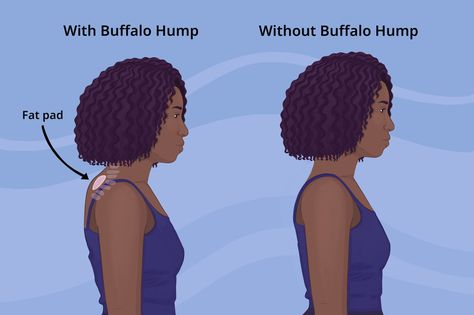 Discover the causes, prevention techniques, and effective solutions to alleviate the discomfort and pain associated with neck hump. - #buffalohump #cervicalhump #cervicalhyperlordosis #dowager'shump #excessivecurvatureoftheupperspine #Forwardheadposture #kyphosis #neckhump #poorposture #Roundedshoulders Back Hump, Cushing’s Syndrome, Dowager's Hump, Neck Hump, Cushings Syndrome, Muscle Stretches, Forward Head Posture, High Cortisol, Types Of Surgery