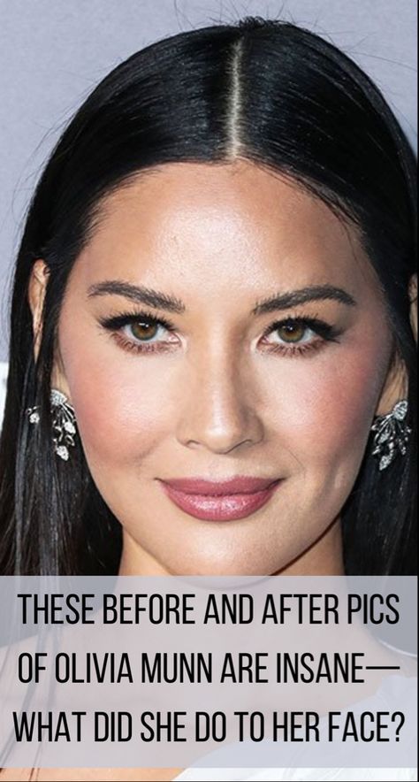 Face Plastic Surgery, Celebrity Surgery, Bad Plastic Surgeries, Cheek Implants, Face Transformation, Plastic Surgery Fail, Botox Before And After, Face Fillers, Plastic Surgery Gone Wrong