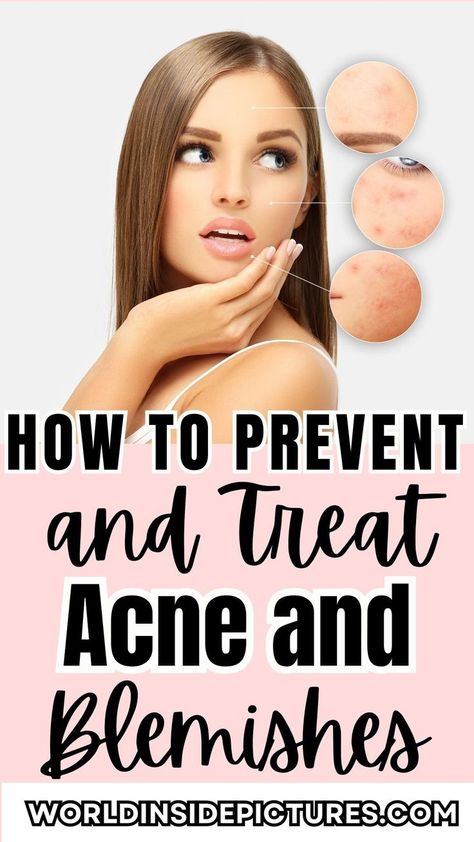 Discover effective strategies to prevent and treat acne and blemishes with our comprehensive guide. Learn valuable tips, skincare routines, and recommended products for clear, radiant skin. Say goodbye to pesky breakouts and achieve a healthy complexion today! Acne Women, Clear Skin Remedies, Skincare For Men, Treat Acne, Your 20s, Skin Blemishes, Hormonal Acne, Tips Skincare, Healthy Glowing Skin