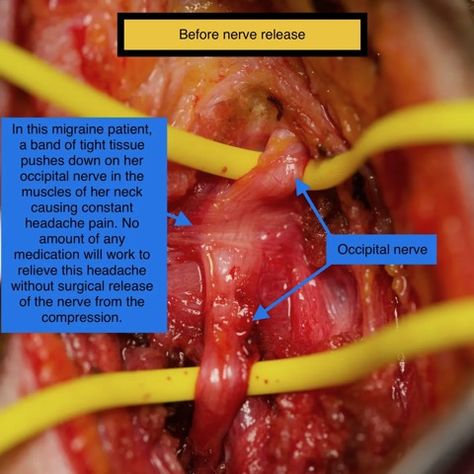 Occipital Nerve Decompression Photos | Migraine Surgery Specialty Center Occipital Neuralgia Relief, Nervous System Anatomy, Sternocleidomastoid Muscle, Occipital Neuralgia, Dysautonomia Pots, Constant Headaches, Neck Problems, Neck Surgery, Severe Headache