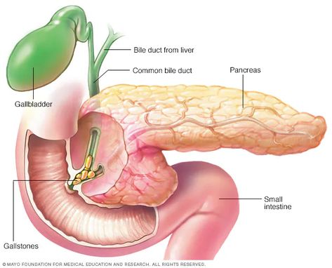 Pancreatitis - Symptoms and causes - Mayo Clinic Pancreatic Diet Recipes, Pancreatic Diet, Digestive System Disorders, Pancreas Health, Liver And Gallbladder, 10 Healthy Foods, Gall Bladder, Digestive Juice, Colon Health