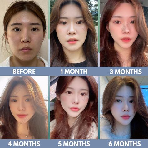 #idhospitalkorea #koreanplasticsurgery #plasticsurgery #plasticsurgerykorea #cosmeticsurgery #seoul #korea #IDtransformation #IDbeforeandafter #plasticsurgerybeforeandafter #beforeandafter #beforeandaftersurgery #besttransformation #vline #vlinesurgery #vshapeface #facialcontouring #cheekbonereduction #ptosiscorrection #eyelidssurgery Manifest Appearance, Cheekbone Reduction, Korean Surgery, Beauty Surgery, V Line Surgery, Plastic Surgery Korea, Korean Plastic Surgery, V Shape Face, Jaw Surgery