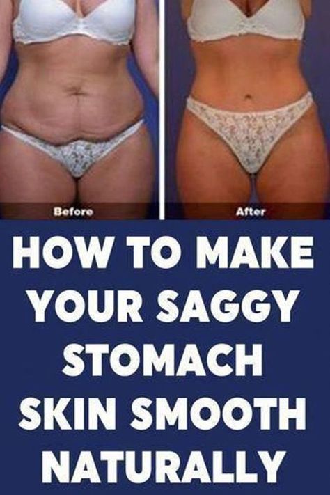 Sagging Belly, Flabby Stomach, Flabby Belly, Tighten Stomach, Sagging Cheeks, Skin Tightening Stomach, Loose Belly, Tighten Loose Skin, Saggy Skin