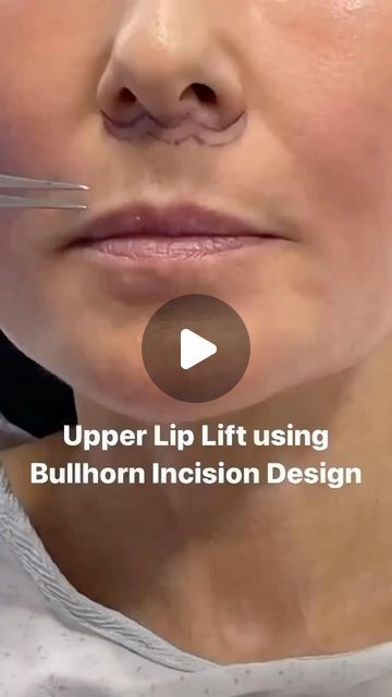 Amir M Karam, MD on Instagram: "Curious about the incision design for an upper lip lift? Well this is how it’s done. 

Little fact… lip lifts have been around for decades but their popularity as a tool took off when the bullhorn incision design became a thing. 

Every once in awhile something like this happens and we take meaningful jump forward. In this case, the incision design makes the scar hardly noticeable and allows for reducing the length back to its youthful level. 

Remember, the upper lip elongates with the rest of the face with aging.  That’s why it’s key to address it at the same time as a Vertical Restore. 

Let me know if this is helpful! 
#knowledgeispower

Share (and save for later) this with anyone you think would enjoy it 🙏🏻😊 

.
.

Schedule a virtual consultation and Argireline Before And After, Lip Lift Surgery Before And After, Lower Face Lift Before And After, Lip Lift Before And After, Lip Lift Surgery, Upper Lip Lift, Upper Lip Wrinkles, Mid Face Lift, Lower Face Lift