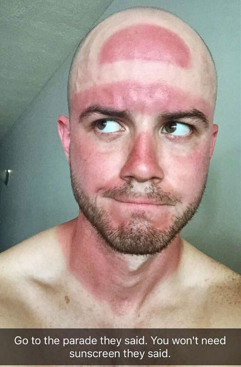 Who Needs A Farmer's Tan When You Can Get A Cavs Finals Hat Burn Funny Sunburn, Sunburn Face, Sunny Day Images, Severe Sunburn, Green Tea Bath, Farmers Tan, Funny Lists, Funny Sun, Bad Sunburn