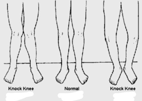 Knock Knees Test: Check yourself at home Knee Workout, Knock Knees, Check Yourself, Medical Examination, Shoe Inserts, Medical Conditions, Growing Old, Healthcare Professionals, Knock Knock