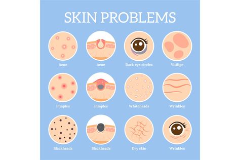 Skin problems. Ages wrinkles problem, face skin infection tr (982557) | Customizable Templates | Design Bundles Letter Of Employment, Back Acne Remedies, Dark Eye Circles, Acne Problem, Skincare Quotes, Dark Circles Under Eyes, Face Acne, Facial Skin Care Routine, Under Eyes