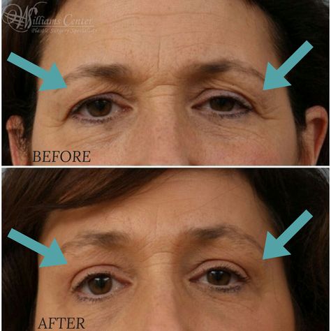 Triple Eyelid, Eyebrow Lift Surgery, Eye Lift Surgery, Forehead Lift, Eyebrow Lift, Eyelid Lift, Upper Eyelid, Botox Fillers, Facial Plastic