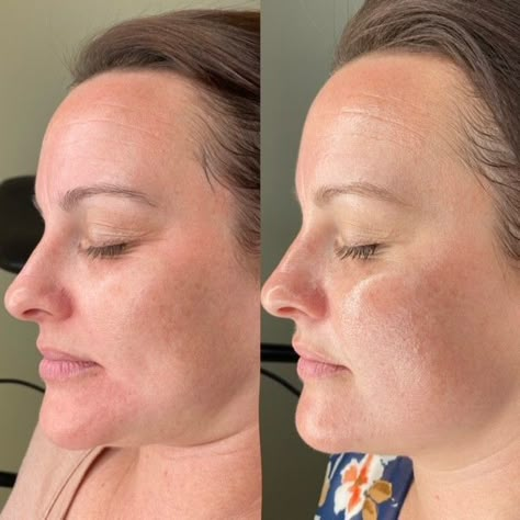 Biorepeel Before And After, Wrinkles Before And After, Retinol Results, Vi Peel Before And After, Retinol Before And After, Chemical Peel Before And After, Chemical Peel Results, Facial Before And After, Vi Peel