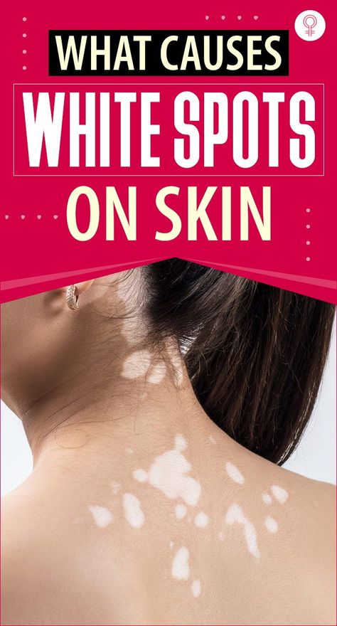 White Skin Patches, White Spots On Skin, White Skin Spots, Face Remedies, Summer Skin Care, Care Routine Aesthetic, Skin Care Routine Aesthetic, Spots On Skin, Tips For Acne