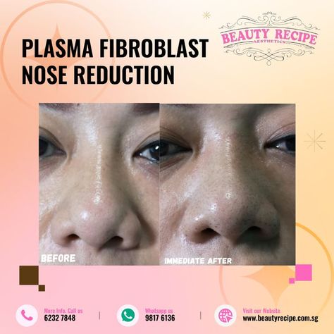 Plasma Fibroblast Nose Reduction Nose Reduction, Nose Lift, Plasma Fibroblast, Non Surgical Facelift, Excess Skin, Eye Lift, Beauty Recipe, Surgery, Education