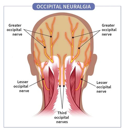 Occipital Neuralgia: Symptoms, Causes, Diagnosis, Treatments, and More Vestibular Migraines Symptoms, Occipital Neuralgia Symptoms, Occipital Neuralgia Relief, Cervical Instability, Autoimmune Disease Symptoms, Nerve Anatomy, Migraine Help, Occipital Neuralgia, Bursitis Hip