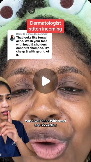 Dr. Neera Nathan on Instagram: "Head & Shoulders is not just for dandruff. It contains pyrithione zinc, which is anti-fungal and antibacterial, making it one of the cheapest home remedies for a variety of skin conditions.

For fungal acne: “Fungal” acne is actually malassezia (pityrisporum) folliculitis and is caused by the same yeast as dandruff. It presents as tiny, itchy monomorphic bumps on the forehead and hairline. H&S can be used as a face wash to help clear this condition. To use as a face wash, lather it on the face, leave it on for 2 minutes, then rinse off. Use 2-3x per week. 

For seborrheic dermatitis: Seborrheic dermatitis is dry, flaky skin that occurs in between/around the eyebrows, on the side of the nose & behind the ears. It is related to dandruff. H&S can be used as a f Forehead Acne Home Remedies, Forehead Acne Remedies, Head And Shoulders For Acne, Tiny Bumps On Face, Tiny Bumps On Forehead, Acne On Forehead, Forehead Acne Cause, Dry Forehead, Forehead Breakout