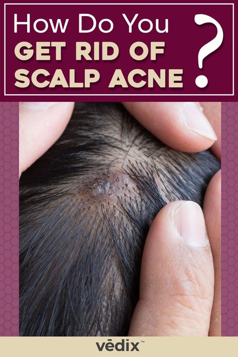 scalp acne Scalp Bumps, Infected Hair Follicle, Nails Remedies, Pimples On Scalp, Head Pimples, Sores On Scalp, Painful Pimple, Scalp Acne, Head Acne