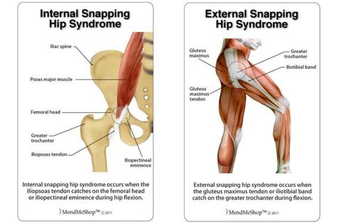 Iliopsoas Bursitis, Snapping Hip Syndrome, Back Pain Exercise, Bike Fitting, Postnatal Care, Greater Trochanter, Iliotibial Band, Gluteus Maximus, Bursitis Hip