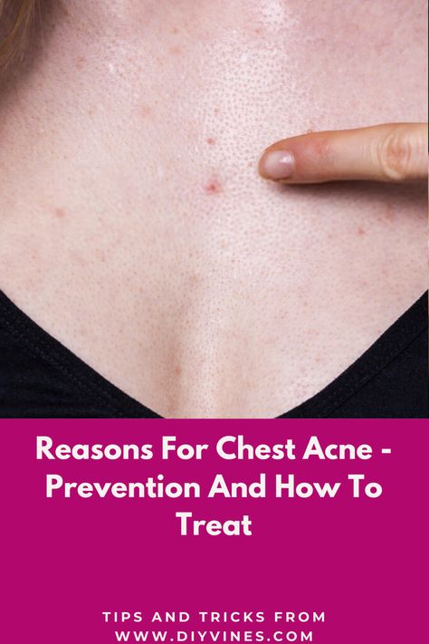 Reasons for chest acne are same as regular acne.  Chest acne is also called body acne. The main reason for Chest  acne is overproduction of sebum by the sebaceous glands. When there is an over production of sebum (skin oil) in body, skin pores become clogged.  #acne #chestacne #acnecauses #acneprevention #acnetreatment #beautytips #DIY #homeremedies Chest Acne Remedies, Acne Reasons, Chest Acne, Blind Pimple, Pimples Under The Skin, Bad Acne, Acne Overnight, Prevent Pimples, Natural Acne