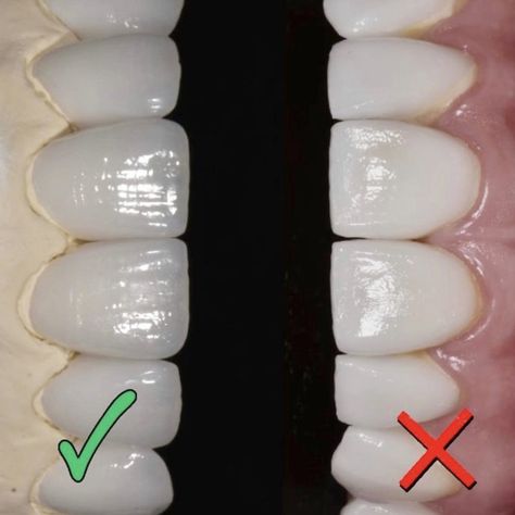 Composite Veneers, Wisdom Tooth Extraction, Old Vs New, Celebrity Smiles, Veneers Teeth, Dental Work, Porcelain Veneers, Straight Teeth, Teeth Implants