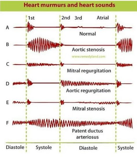 Cardiac Notes, Heart Murmurs, Patent Ductus Arteriosus, Heart Diagram, Medical Things, Heart Sounds, Medical Notes, Health Assessment, Cardiac Nursing