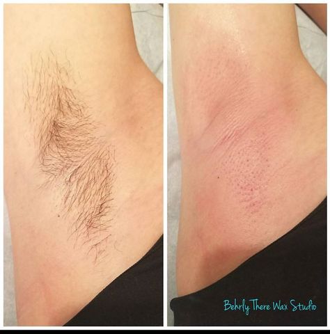 Before and after underarm wax #dayton #ohio #brazilianwaxing #waxing #esthetician #eyebrowwaxing #lashlift #lashtint #browtint #beforeandafter #underarmwax Waxing Esthetician, Waxing Studio, Underarm Waxing, Laser Skin Rejuvenation, Wax Studio, Tattoo Cream, Lash Tint, Skin Aesthetics, Facial Treatments